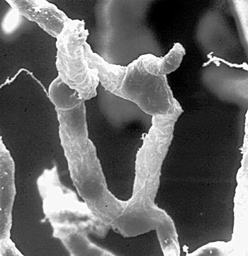 Leaky brain linked to dementia