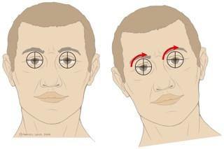 Head Tilts May Signal A Brain Problem