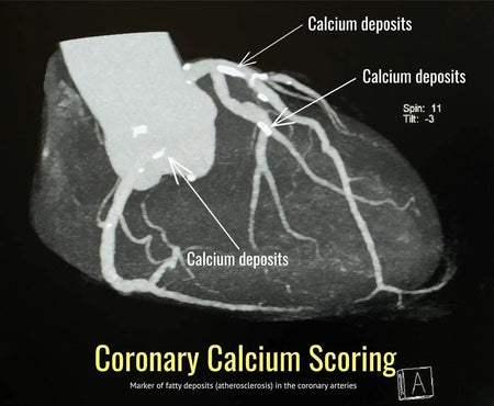 CT scan showing coronary arteries with labeled calcium deposits, coronary calcium scoring